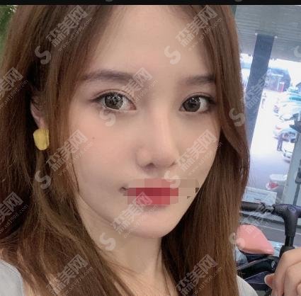 成都军大整形医院做的双眼皮案例如何?公布价格表和成功案例