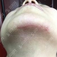 湖南省人民医院治疗疤痕怎样？祛疤果图前后对比，疤痕不见了!
