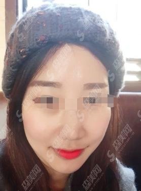 北京八大处口碑如何，王太玲医师做的光子嫩肤如何？真人案例前后对比