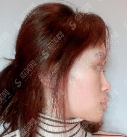 华美整形医院皮肤科是较牛的医院吗?内附光子嫩肤价格表,案例果分享