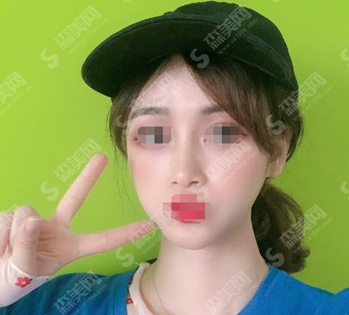 华美整形医院皮肤科是较牛的医院吗?内附光子嫩肤价格表,案例果分享