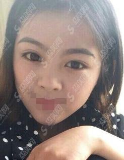 秦皇岛巧致整形做的隆鼻果如何?周海燕医师口碑如何?真人案例恢复果