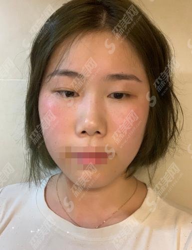 2021美白价格多少？西安美莱案例反馈及价格表明细