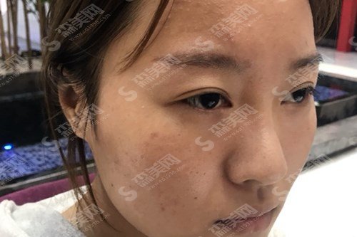 沈阳整形外科三甲医院有哪些?上榜的医院综合实力介绍,内含隆鼻手术案例的恢复果图!