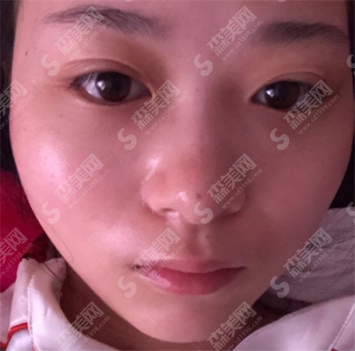 福州市第一医院整形科价格表如何?医院整形专家盘点+恢复案例