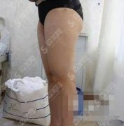 六安市人民医院医学美容中心价目表2021，大腿吸脂案例分享看看美不美呦！