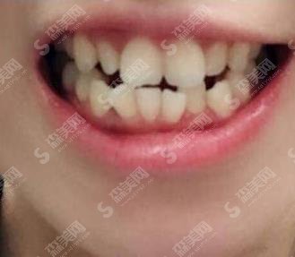 贵阳市口腔医院价格表查询，正畸案例详情介绍