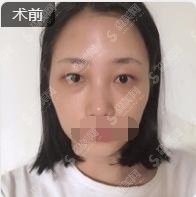 上海九院好的案例分享，眼部溶脂整形价格表一览，内含医生介绍