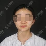 沈阳改脸型中心较厉害医院分享，内附案例果及价格明细