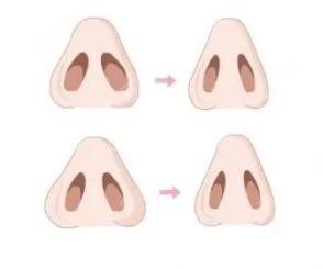 什么是鼻孔缩小？鼻孔缩小的术前术后果如何？内含鼻部整形较新价格一览