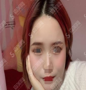 激光美肤祛斑10天变化图片对比，内附逆天术激光美肤案例价格表明细