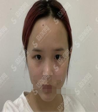 激光美肤祛斑10天变化图片对比，内附逆天术激光美肤案例价格表明细
