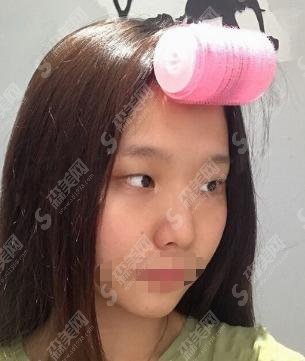 上海lj医院做的双眼皮怎么样？医院的医师团队如何？案例分享
