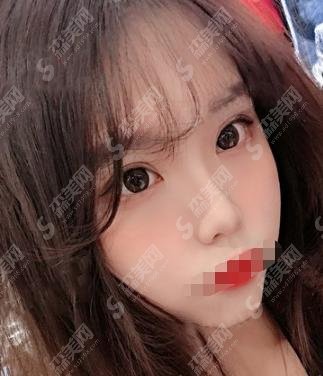 上海lj医院做的双眼皮怎么样？医院的医师团队如何？案例分享