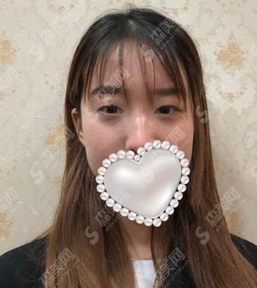 八大处美容整形价目表分享,双眼皮项目做得较为不错!真实案例不容错过!
