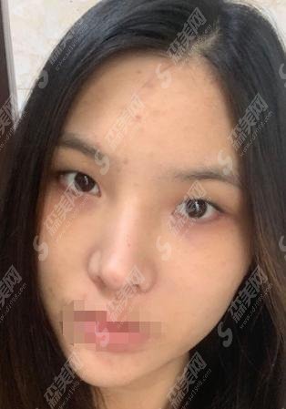 南阳维多利亚整形医院双眼皮价格明细，内含医院介绍和双眼皮前后对比