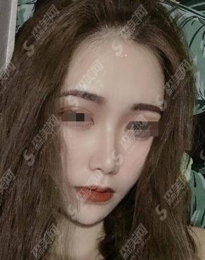 漯河市中心院整形科做的隆鼻怎么样？漯河市中心整形科怎么样？附医师介绍及案例分享