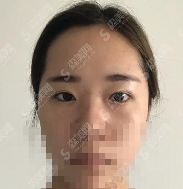 滕州人民医院做双眼皮怎么样?果出奇的好,术后自然度较为高!