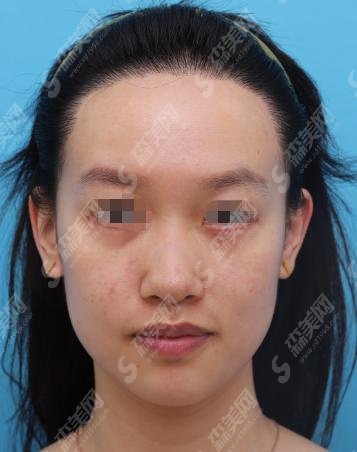 三门峡市中心医院隆鼻医生推荐？林海霞好不好？口碑价格表一览