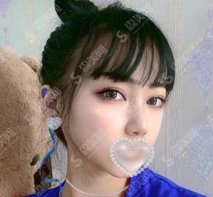 溶解酶溶解玻尿酸多少钱？简直是玻尿酸案例失误的克星！
