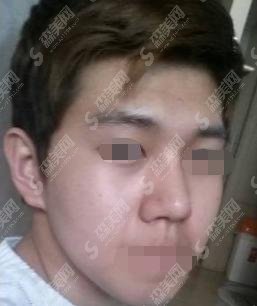 男生隆鼻梁对比图展示，果还是较为的完美的！