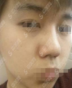 男生隆鼻梁对比图展示，果还是较为的完美的！