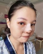 湘西州人民医院整形科鼻部手术案例，价格表查询及术后恢复果
