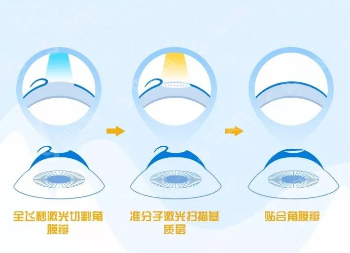 重庆大坪医院眼科半飞秒近视矫正技术怎么样？医院的实力特点和案例恢复果赏析统统可以查询！