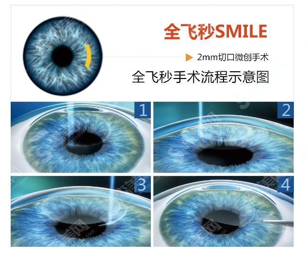 聊城爱尔眼科医院全飞秒激光近视手术怎么样?近视眼手术的果一览,同时附带了医院的实力介绍和医生名单！