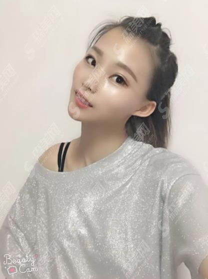 贵阳市口腔医院价格表查询,含牙齿矫正基本流程及照片对比