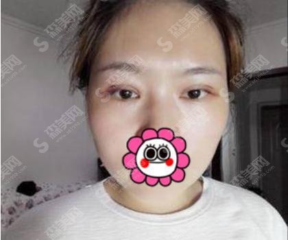揭开黄石市第五医院整形科光子嫩肤果好的秘密及医院医生详细介绍