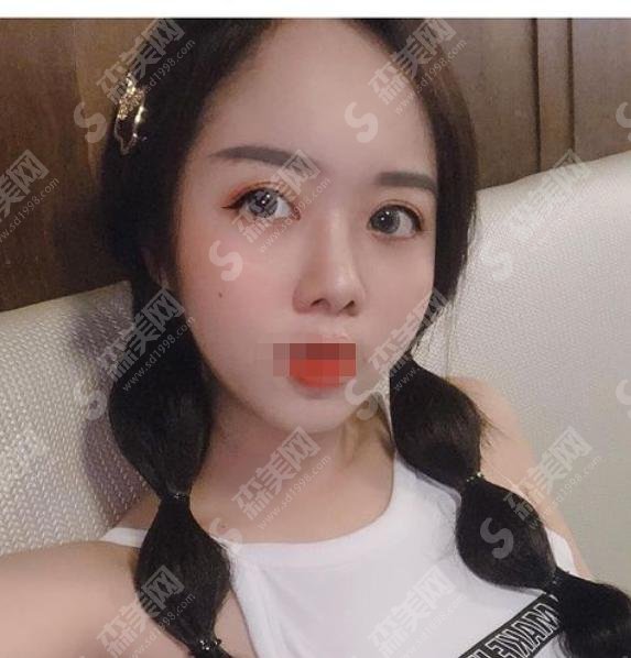 打了注射瘦脸一年后图片，你一定没有见过，来看看吧！