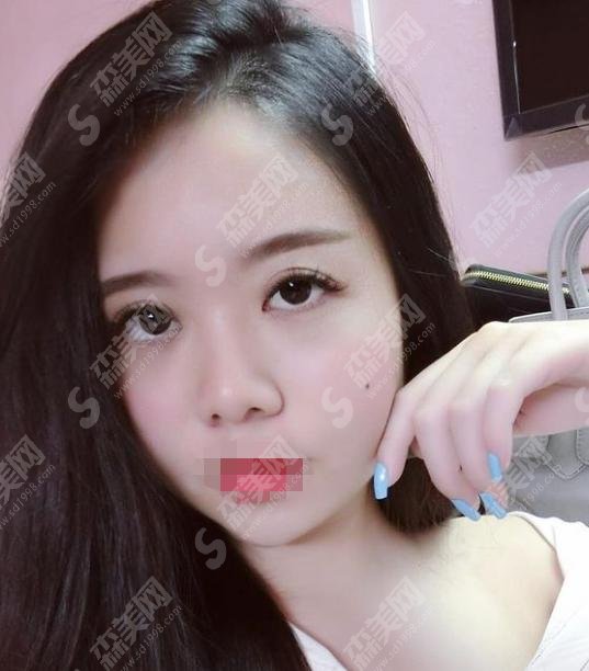 打了注射瘦脸一年后图片，你一定没有见过，来看看吧！