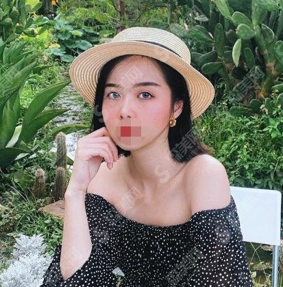 打了注射瘦脸一年后图片，你一定没有见过，来看看吧！