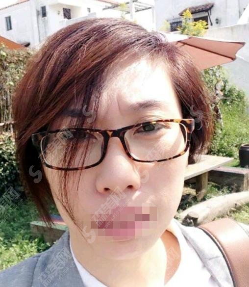 注射瘦脸和注射瘦脸哪个好？两者都还不错，一起来看看吧！