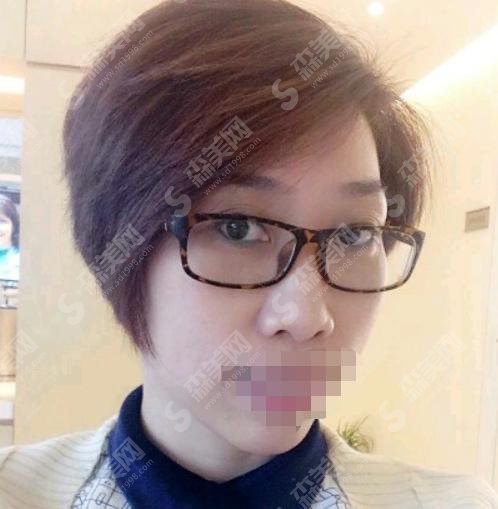 注射瘦脸和注射瘦脸哪个好？两者都还不错，一起来看看吧！