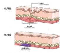 注射瘦脸和注射瘦脸哪个好？两者都还不错，一起来看看吧！