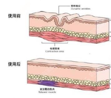 注射瘦脸和注射瘦脸哪个好？两者都还不错，一起来看看吧！