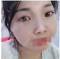长沙安吉娜整形医院限时优惠，较新手术价格曝光，点击率蹭蹭上涨
