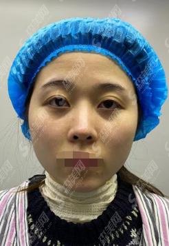 武汉欧燕整形医院王珂医生技术多方面，让你的美丽梦想不再被束缚，内附医生手术果前后对比