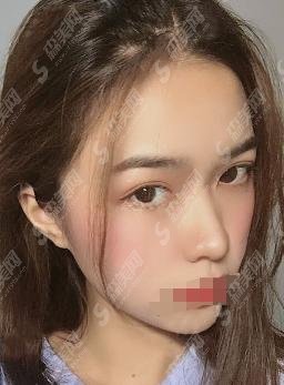 海宁市人民医院医疗美容科实力如何？医生双眼皮案例果让人长见识