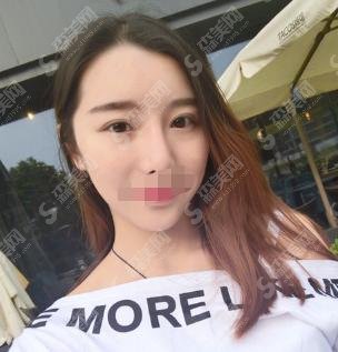 广东省第二人民医院整形美容科做的双眼皮果明X,孙宗生医生被持续关注