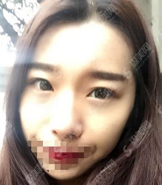 广东省第二人民医院整形美容科做的双眼皮果明X,孙宗生医生被持续关注