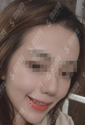 沈阳医大四院整形美容科实力如何？ 陈伟华医生真实案例果分享满意度极高