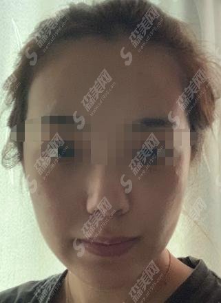 沈阳医大四院整形美容科实力如何？ 陈伟华医生真实案例果分享满意度极高