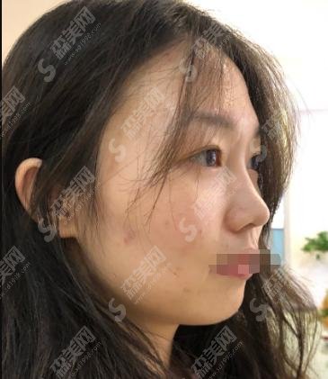 山西白求恩医院美容整形科隆鼻果怎么样?刘青梅医生为您保驾护航