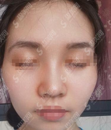 山西白求恩医院美容整形科隆鼻果怎么样?刘青梅医生为您保驾护航