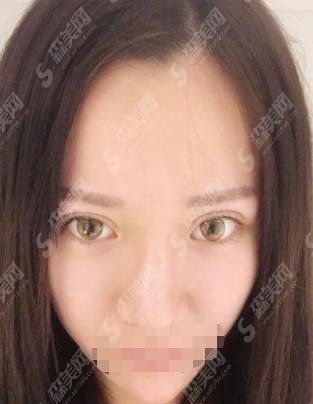 南平市第一医院整形科隆鼻果在线展示，附项目收费情况一览