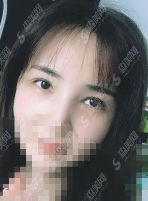 凉山州第二人民医院整形科实力好到离谱,面部拉皮手术果让你折服