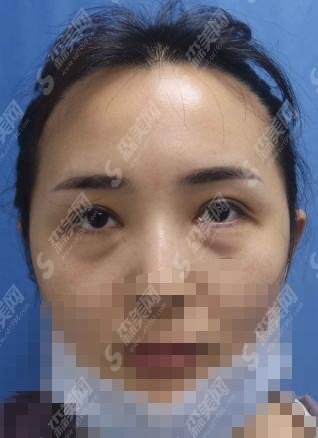 凉山州第二人民医院整形科实力好到离谱,面部拉皮手术果让你折服